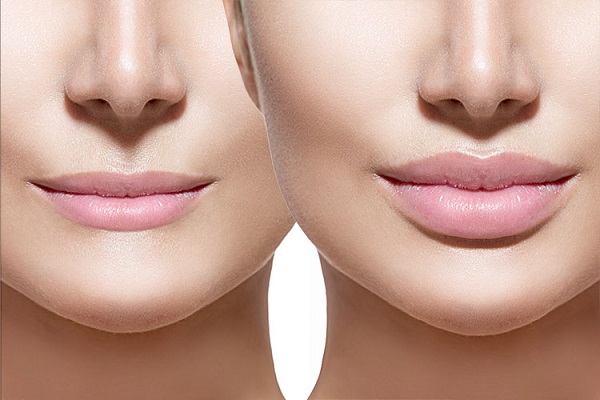 How Often Should Lip Filling Be Renewed?