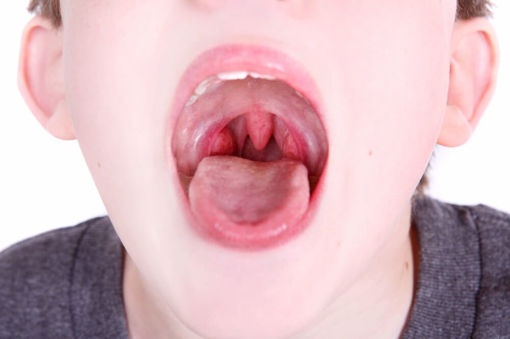 Symptoms of Croup Disease