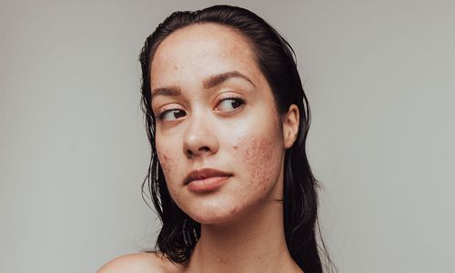 ​What Is Good for Acne Scars?