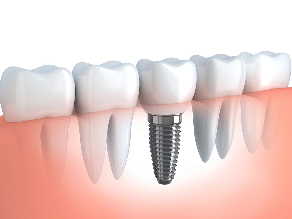 How is Implant Bone Transplantation Performed?