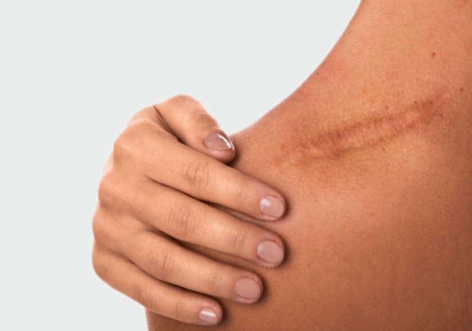 What Is Good for a Burn Scar?