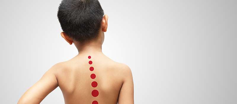 Scoliosis Symptoms in Children