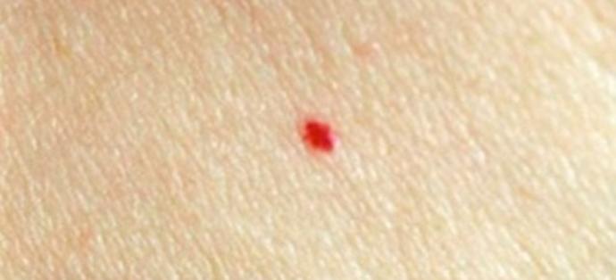 Why Does cherry angioma Come Out?