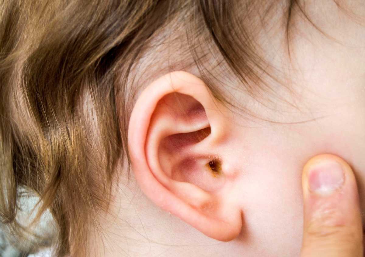 What is otitis media?