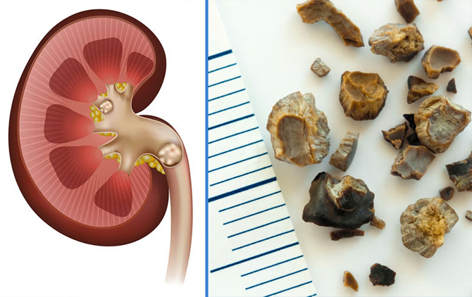 What should kidney stone patients pay attention to?