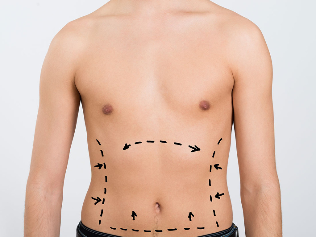 ​Liposuction (Vacuum Fat Extraction Surgery)