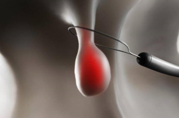 What are the Treatment Methods of Polyps?