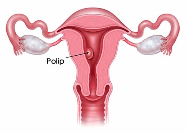 WHAT IS A POLYP IN THE BOTTOM?