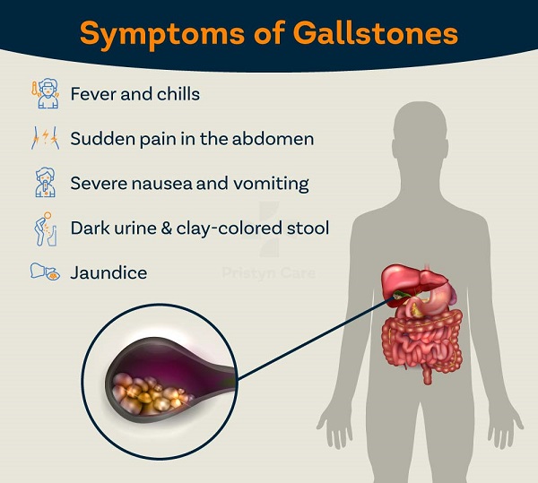 Treatment options for gallstnes include:
