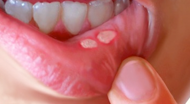 What Is a Mouth Wound?