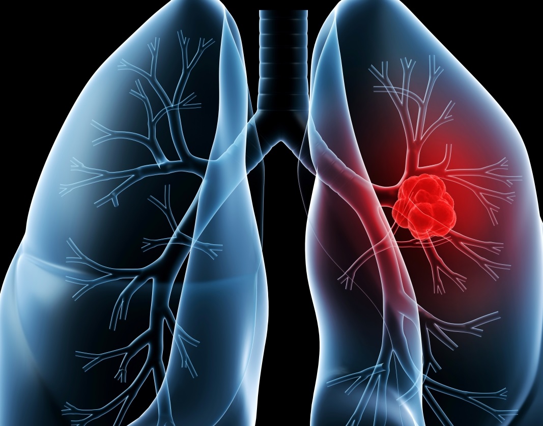 Treatment of small cell lung cancer