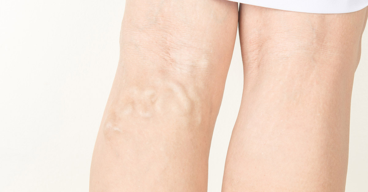 What is varicose veins treatment?