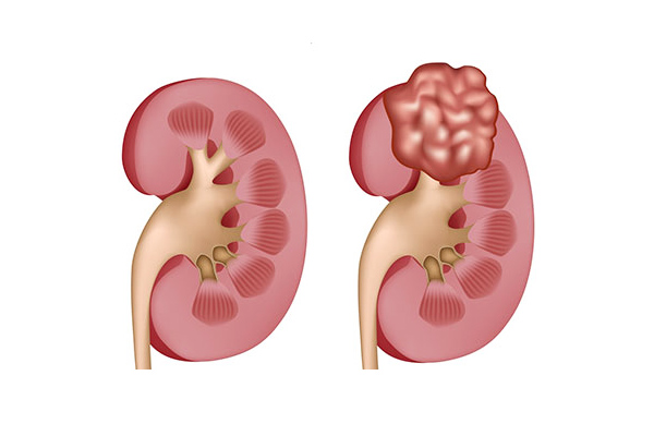 What is Adrenal Gland Tumor (Peochromocytoma)?