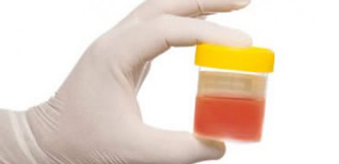 WHAT ARE THE CAUSES OF URINE BLEEDING?