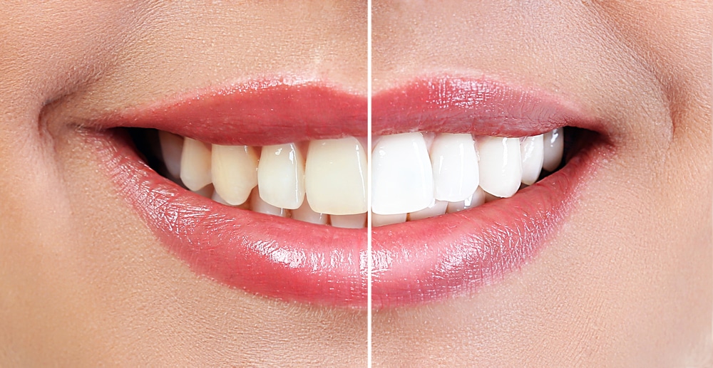 Is Teeth Bleaching Harmful?
