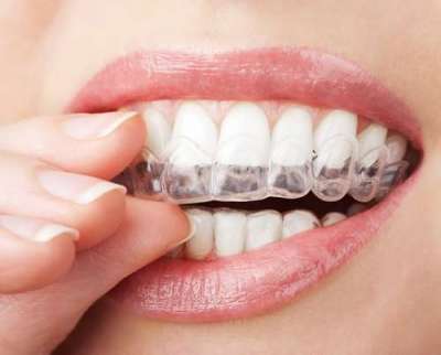 What is Bruxism (Tooth Clenching)?