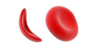 What is sickle cell anemia ?