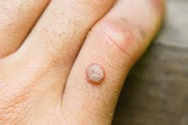 What is a Wart?