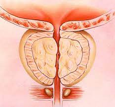 What is prostate cancer?