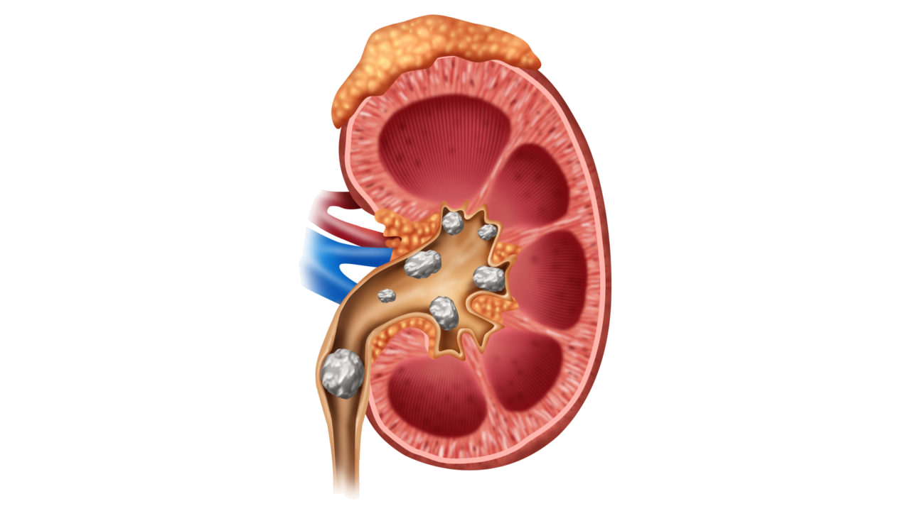 What should kidney stone patients pay attention to?