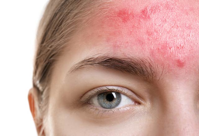 What is Seborrheic Dermatitis?