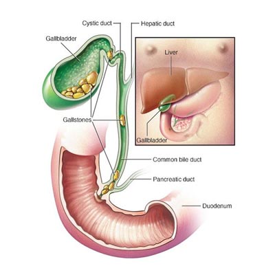 Why do gallstones form