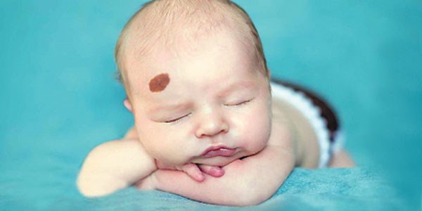 What is a Birthmark?