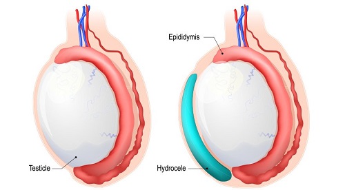 What is a hydrocele?