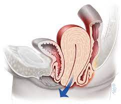 What is pelvic organ prolapse