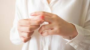 What is butterfly disease (Lupus)?