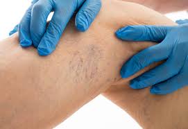 To protect against varicose;