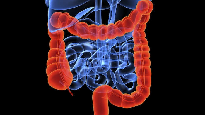 Do polyps of the large intestine turn into cancer