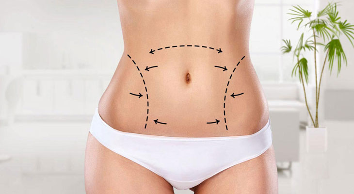 What is Tummy Tuck Aesthetics?