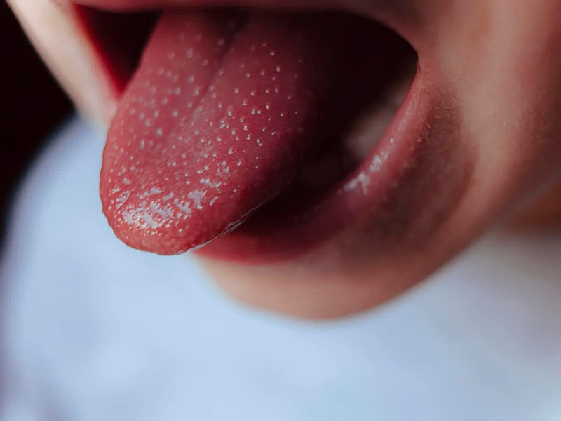 What is Kawasaki Disease?