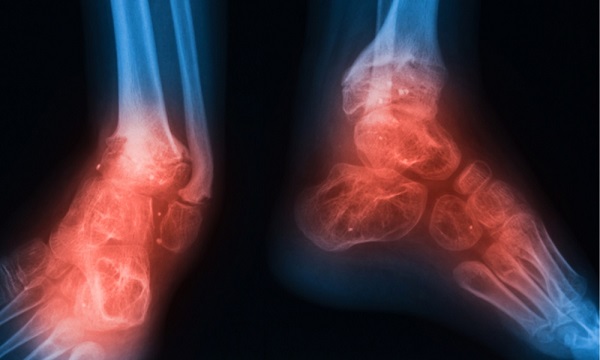 CAUSES OF BONE INFLAMMATION