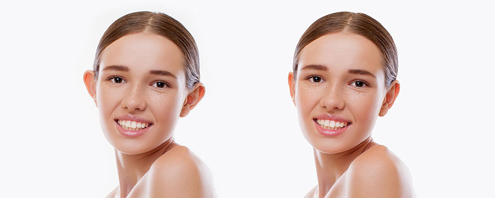 What is the Age of Scone Ear Surgery (Otoplasty)?