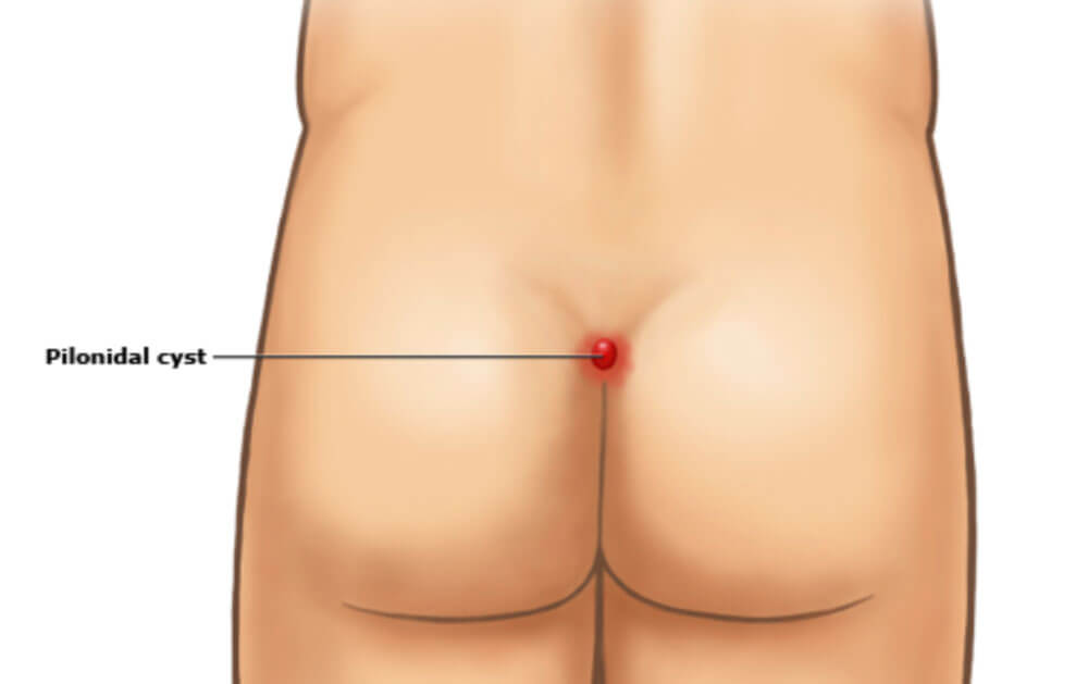 What is ingrown hair (Pilonidal Sinus)?