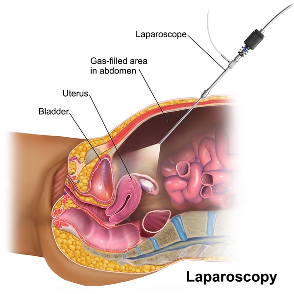 What is laparoscopy ?