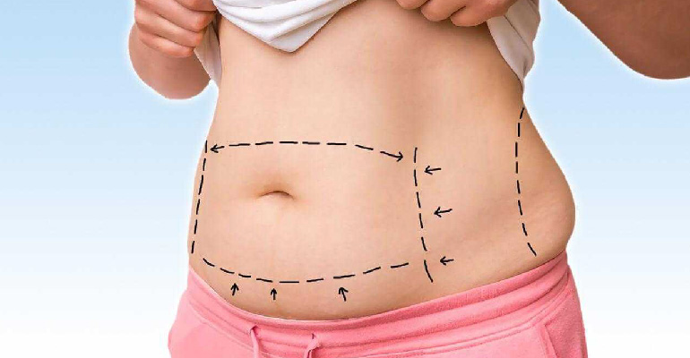 What is Laser Lipolysis?