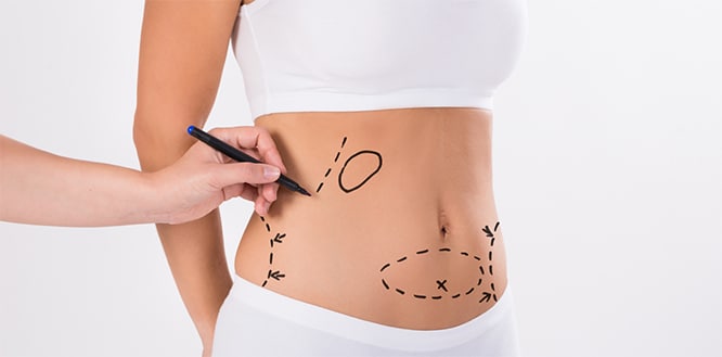 Liposuction Surgery