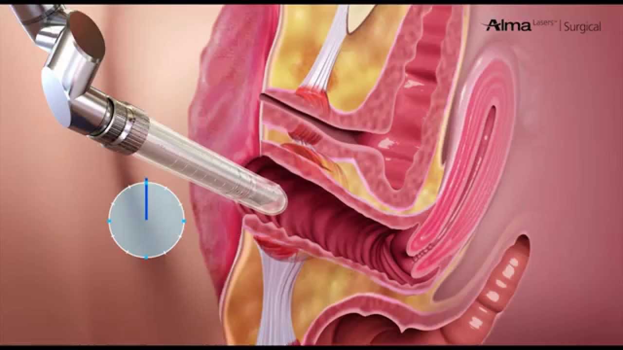 How is incontinence treated?