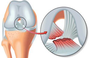 What is a Meniscus Tear?