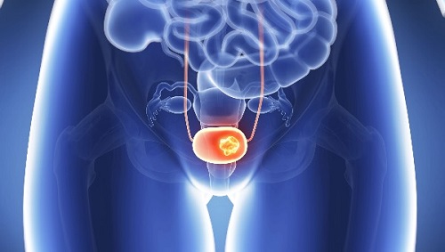 What is Bladder Cancer?