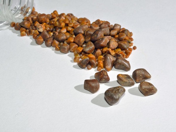 What are gallstones?