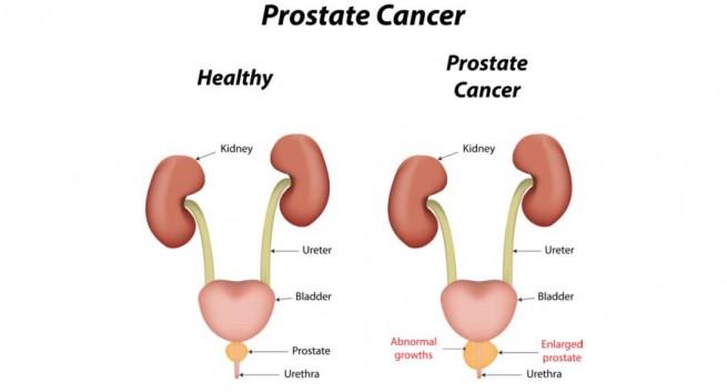 What is prostate cancer?