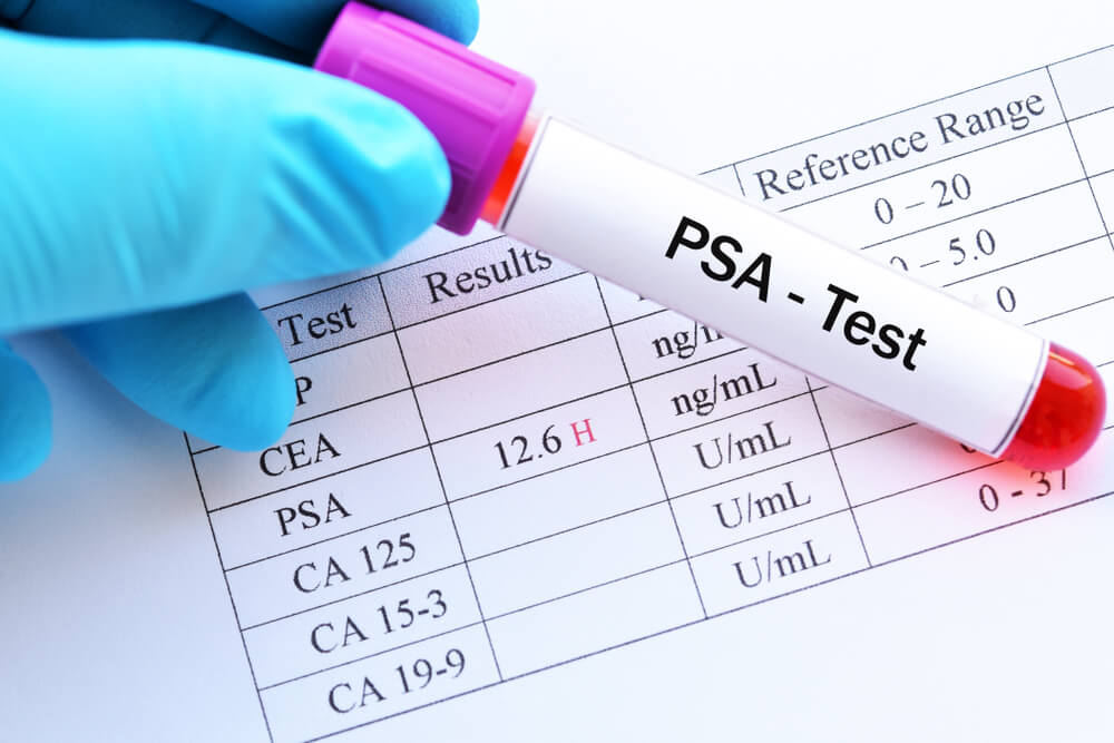 What is the PSA test?