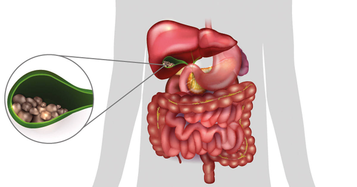 Inflammation of the gallbladder What is cholecystitis?
