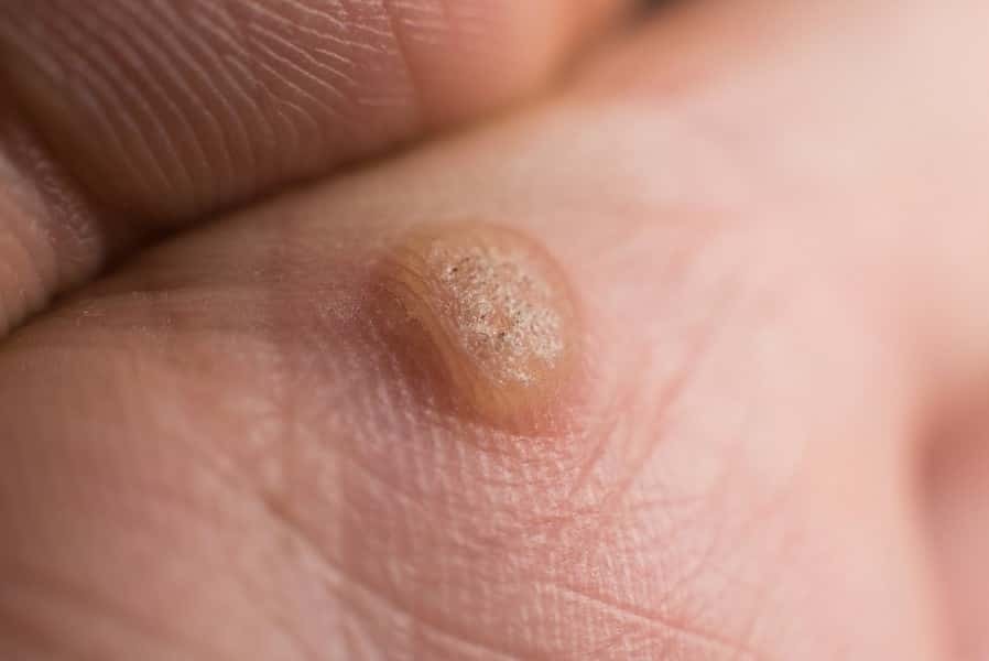 What is genital wart ?