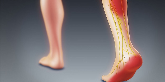 What is sciatica?