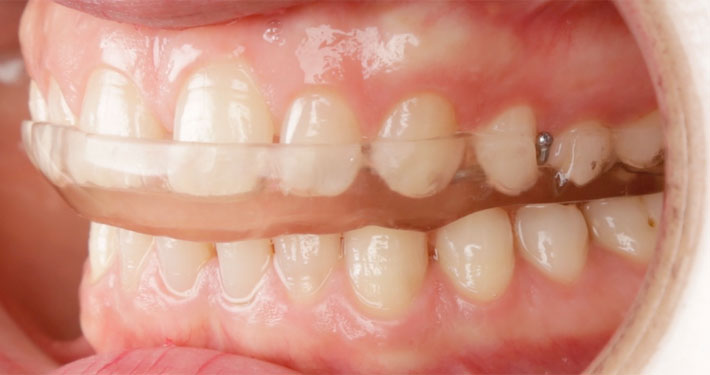 What is Splint? In what cases is it applied?